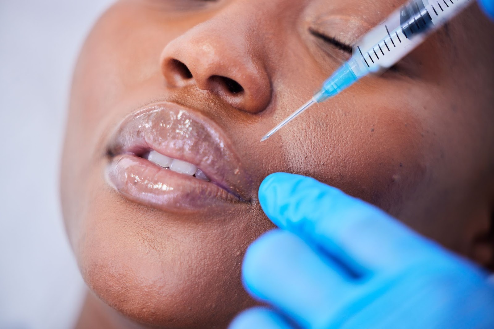 What Are Dermal Fillers?